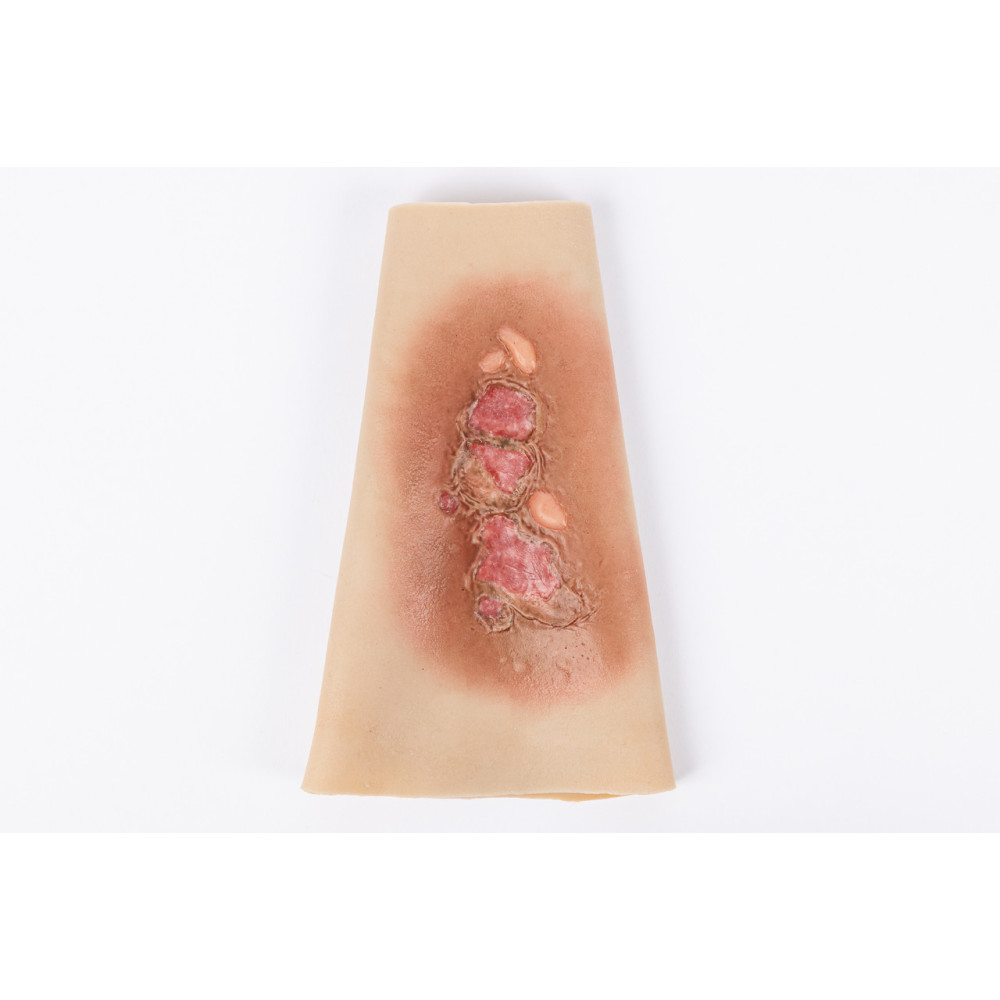 TRAUMASIM Wearable Small/Large Burn - Forearm